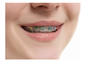 Invisalign Authorised Orthodontist